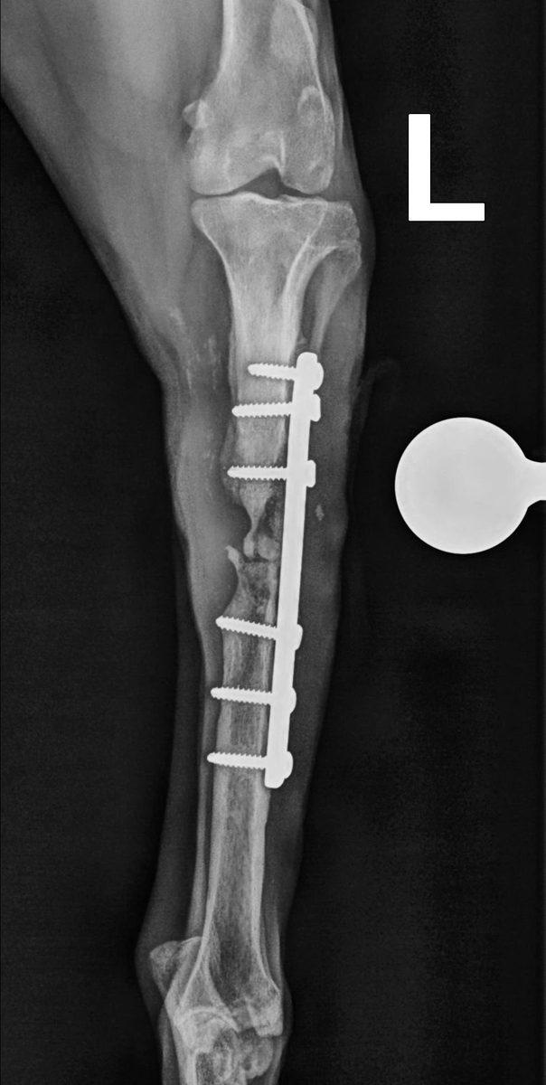 Post-operative radiograph VD view showing orthogonal plate fixation left tibia