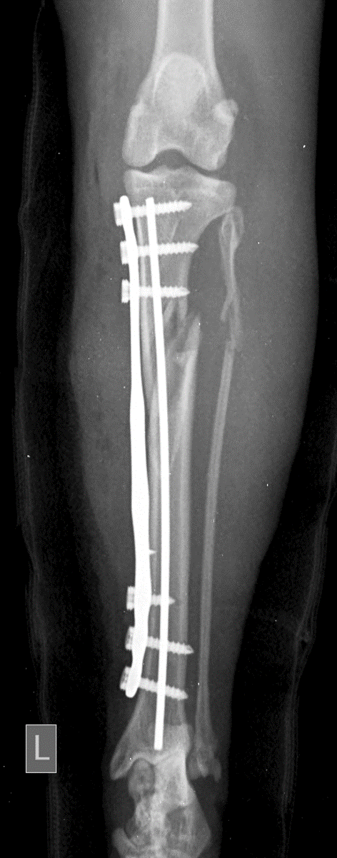Post-operative radiograph — right view