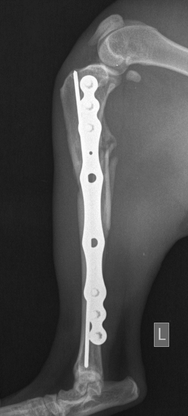 1-month post-op radiograph showing bone healing