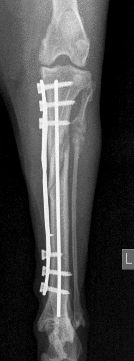 1-month post-op additional radiographic view