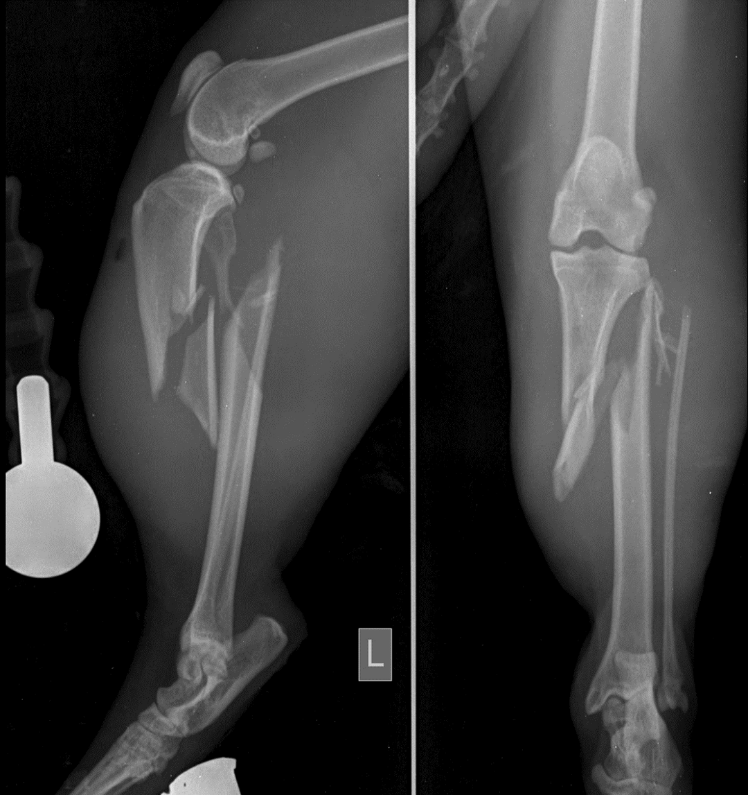 Pre-operative radiograph of the tibial fracture