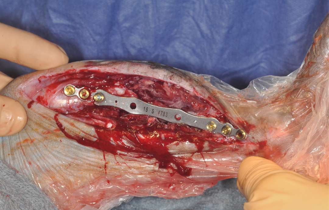 Wound debridement at the fracture site