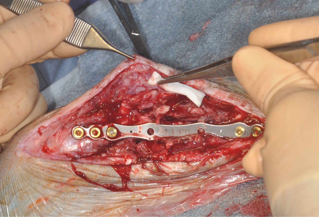 Gentacoll gentamicin collagen sponge placed at fracture site