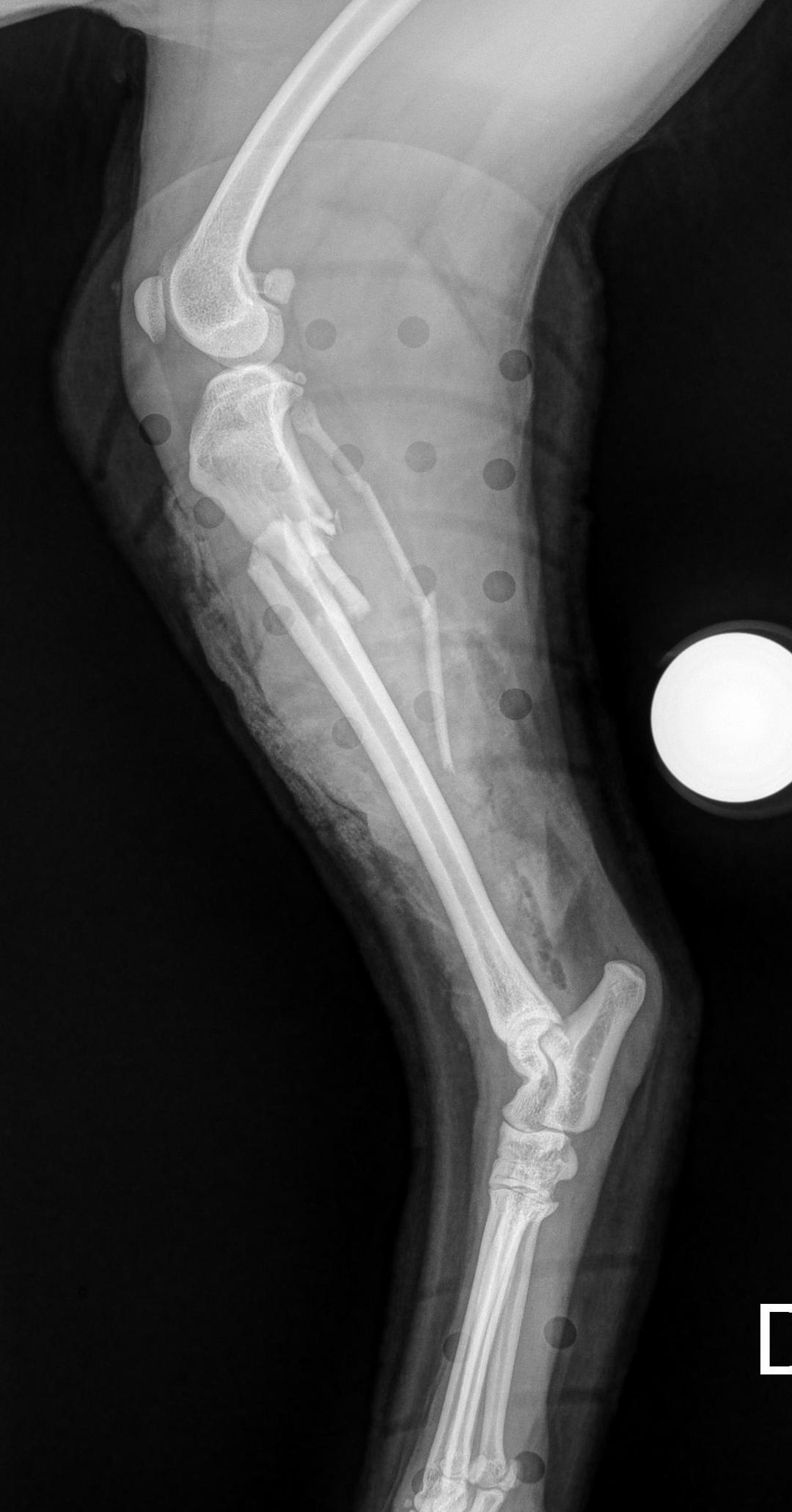 Pre-operative radiograph showing open comminuted tibia/fibula fracture