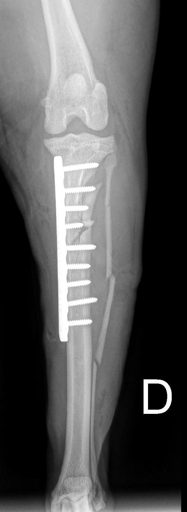 2-month radiograph confirming complete bone healing
