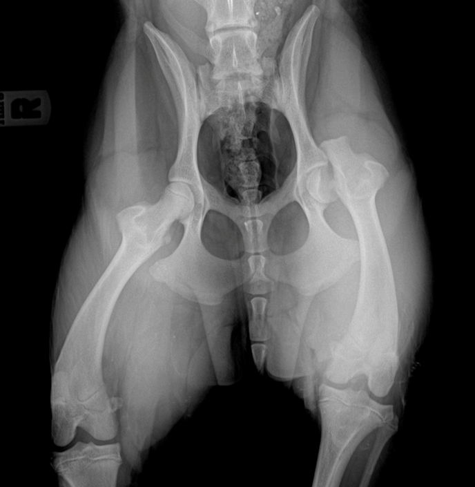 Pre-operative radiograph of the left hip showing severe degenerative joint disease