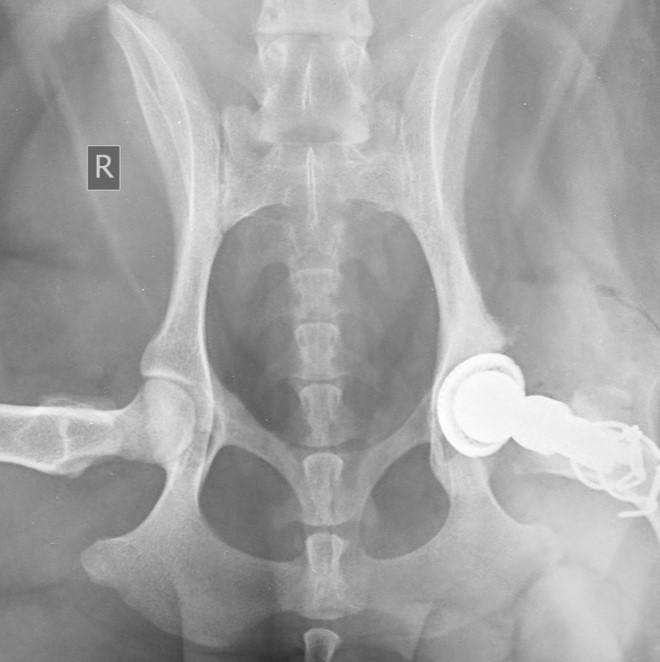 Post-operative radiograph right view