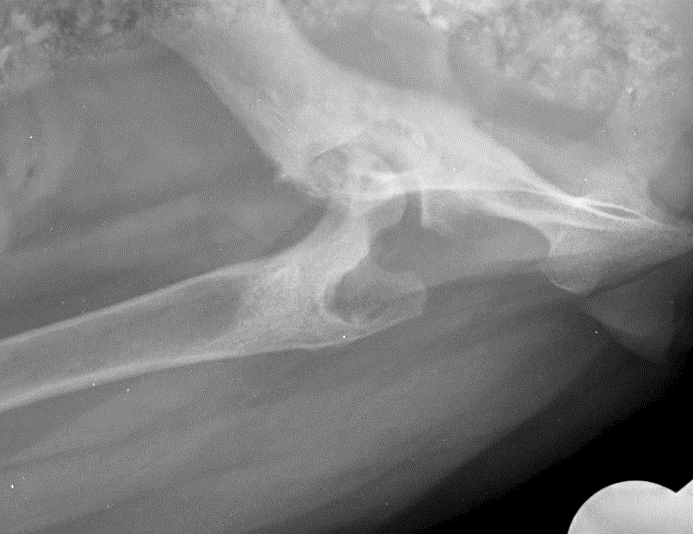 Intraoperative — femoral stem and cerclage wires