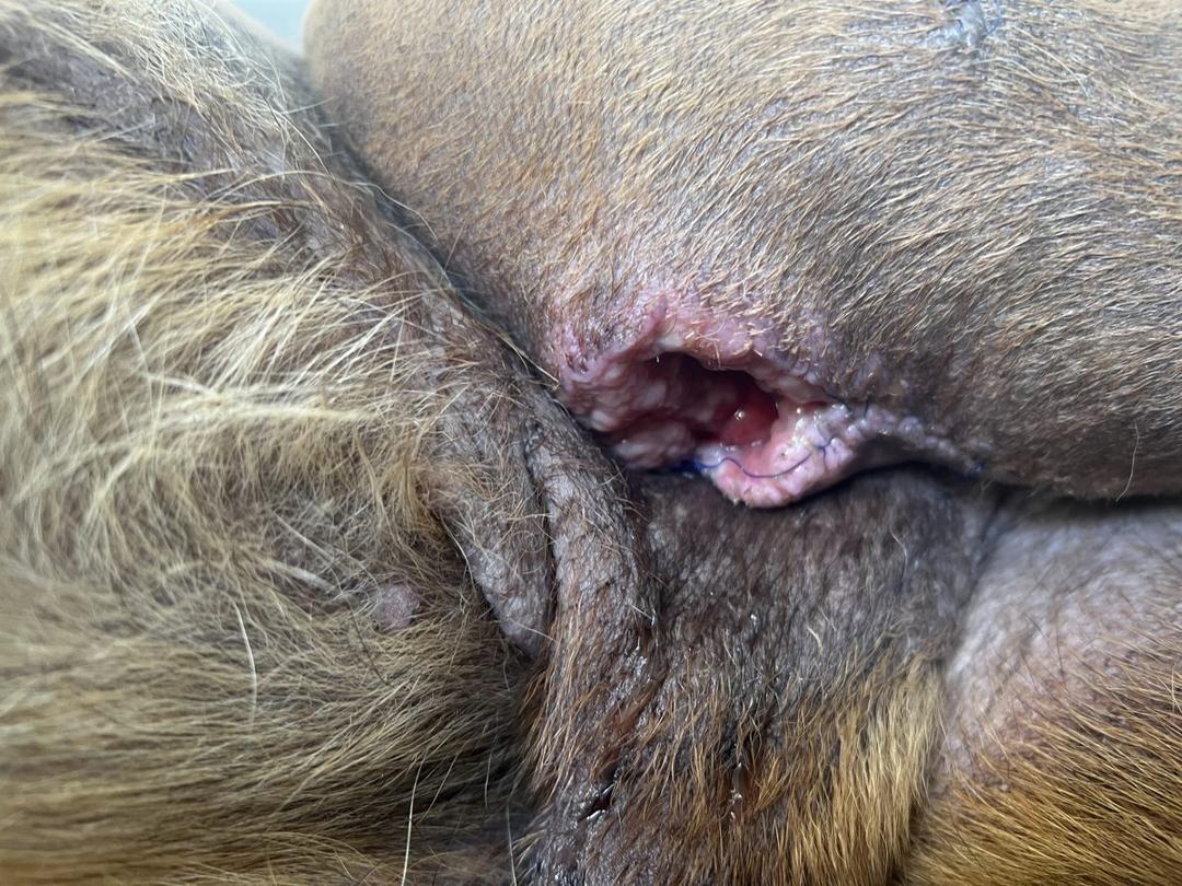 Wound dehiscence 15 days after second surgery