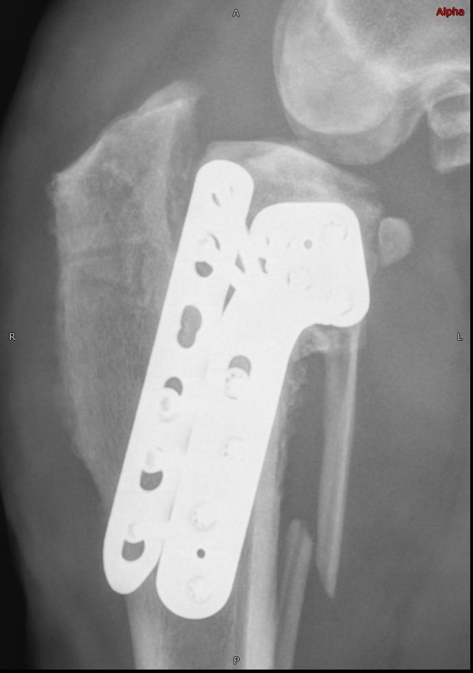 Radiograph showing no bone healing at TPLO site