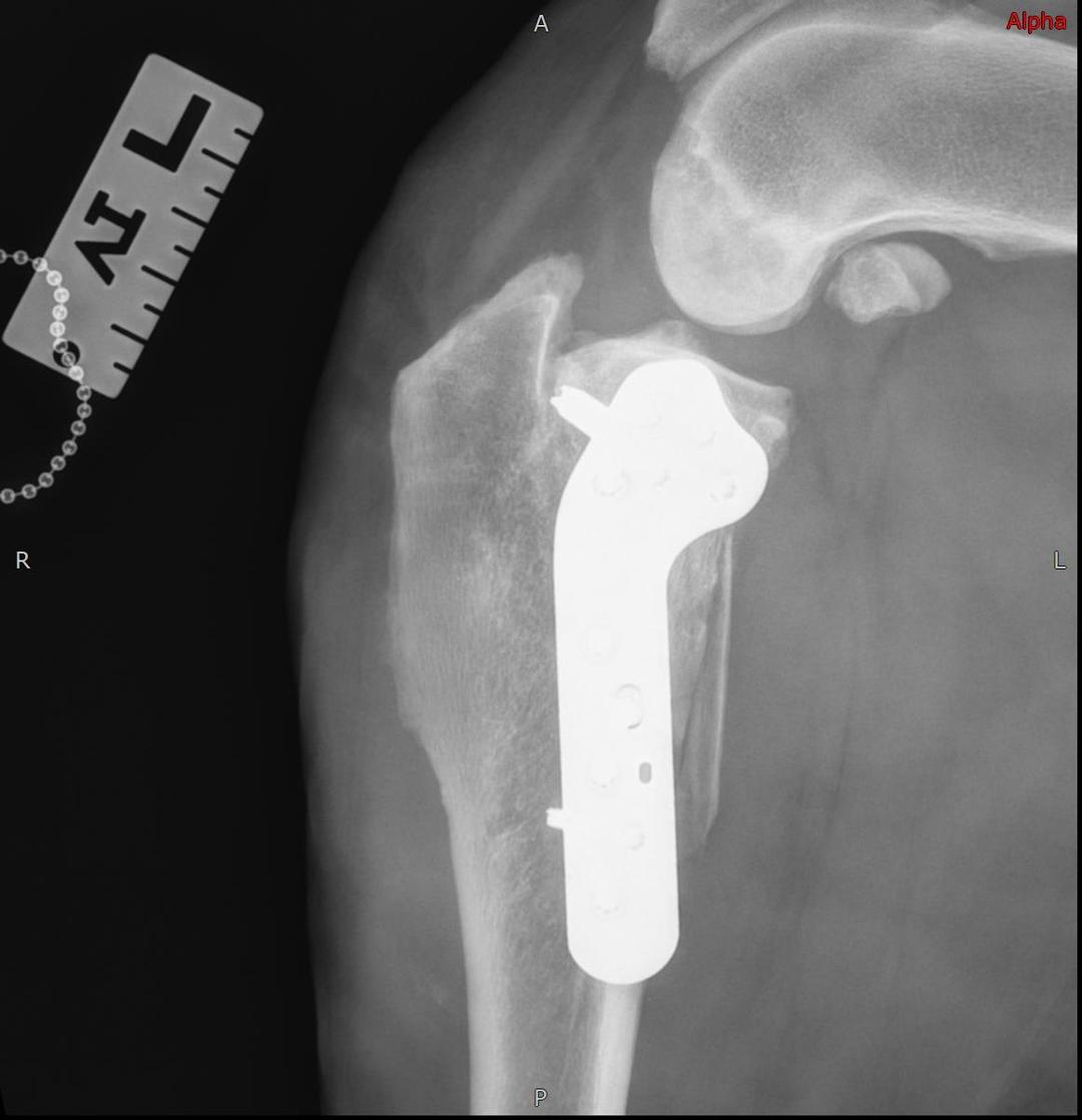 Follow-up radiograph showing bone fusion at 2 months