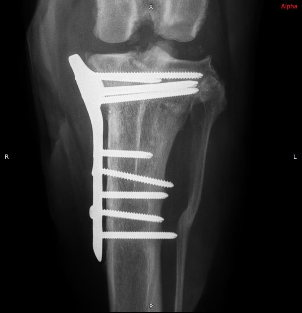 Radiograph after implant removal at 6 months