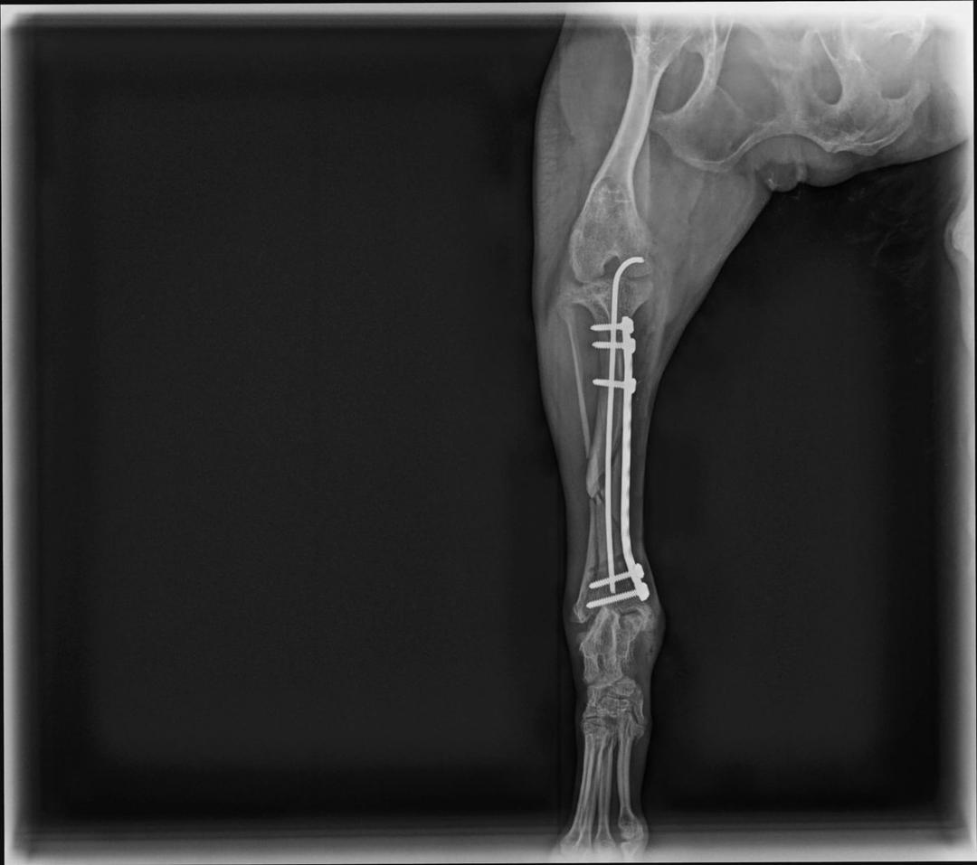 Post-operative radiograph showing intramedullary pin and bridging plate fixation of left tibia