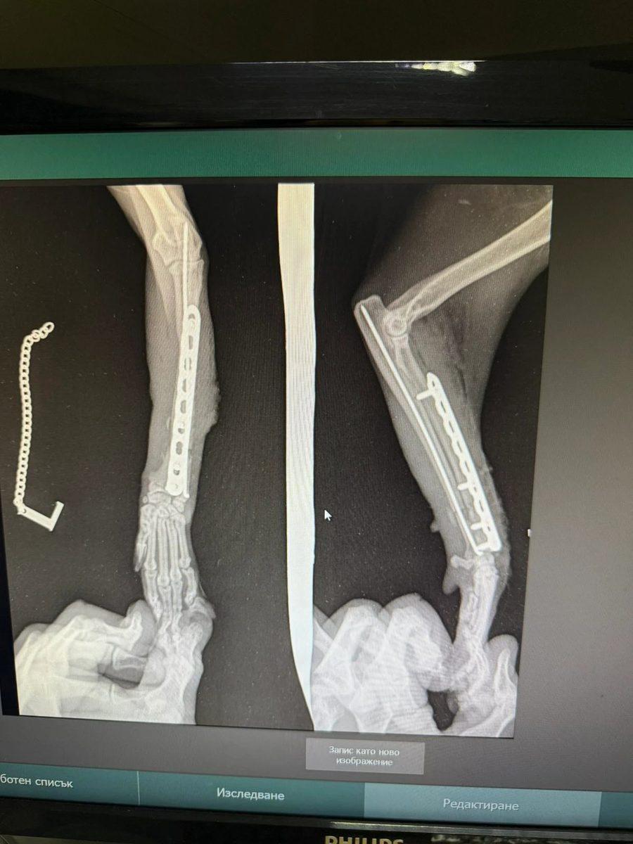Post-operative radiographs VD and lateral showing plate fixation of radius and ulna